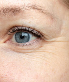 Before Botox Treatment