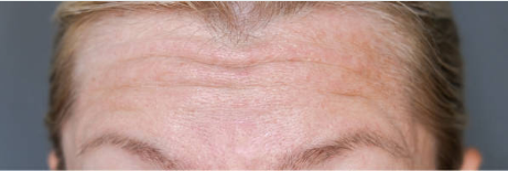Before Botox Treatment