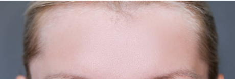 After Botox Treatment