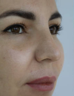 Before Filler Treatment