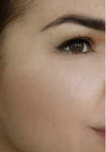 After Filler Treatment