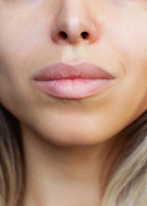 After Lip Filler